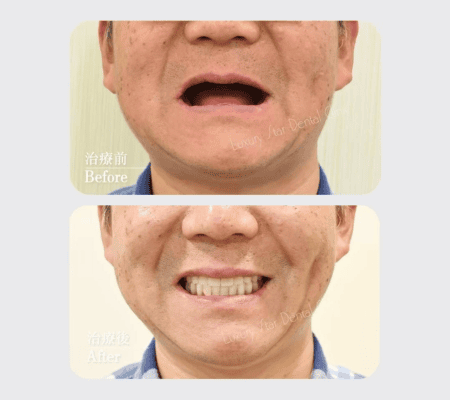 重拾自信，全新生活 All on 4全口重建故事